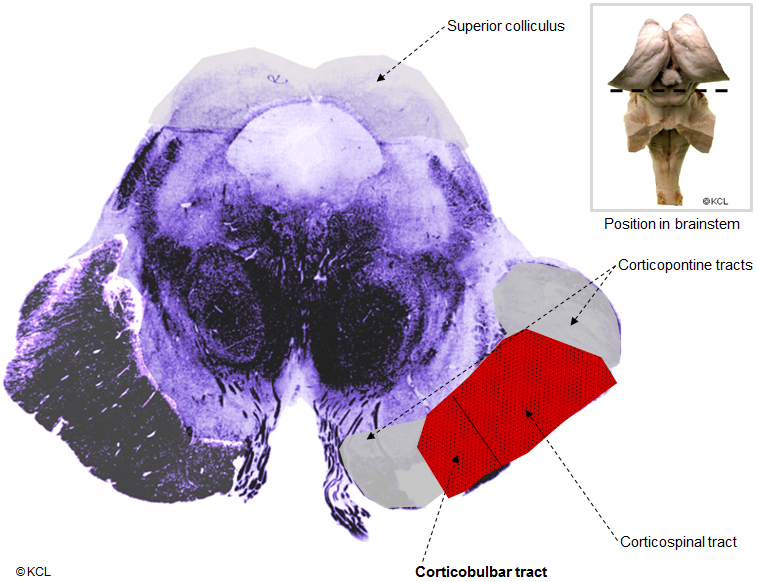 Corticobulbar tract > transverse section at level of superior colliculus