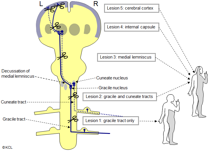 dorsal column tract lesions