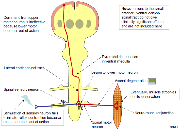Lower motor neuron lesion: of the spinal motor neuron