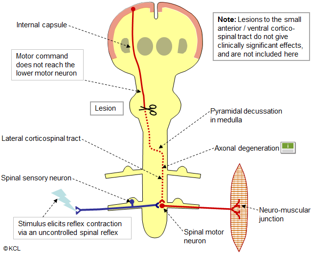 Lesion of corticospinal pathways: above decussation