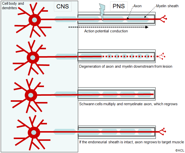 Effects of an axonal lesion of a peripheral nerve (anterograde degeneration)