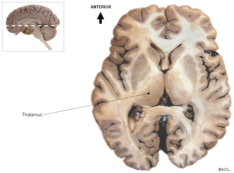 Thalamus - viewed in horizontal brain section