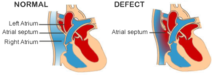 Atrial septal defect (ASD) 