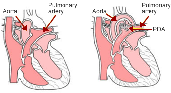 Persistent ductus arteriosus (PDA)