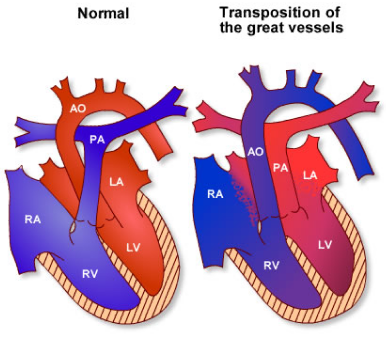 A normal heart and one showing transposition of the great vessles