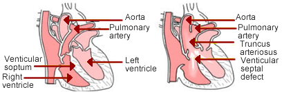 Truncus arteriosus