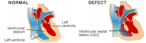 Ventricular septal defect (VSD)