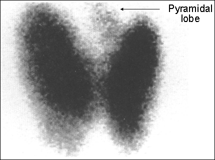 99m Tc Thyroid scan large image