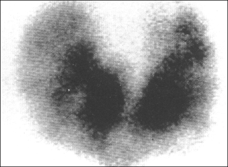 Graves disease in a MNG - 99m Tc Thyroid scan large image