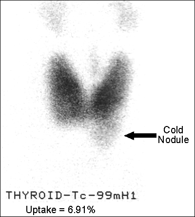 Graves' disease with unsuspected cold nodule large image