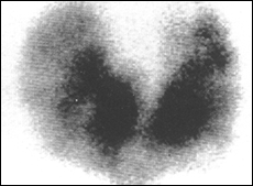 Graves disease in a MNG - 99m Tc Thyroid scan