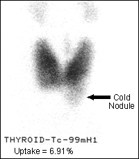 Graves' disease with unsuspected cold nodule