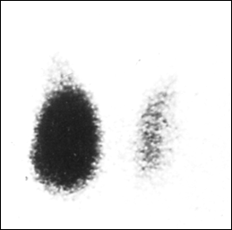 Image A: 99m Tc Thyroid scan with toxic nodule in right lobe and developing supression of left lobe large image