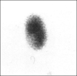 Image B: 99m Tc Thyroid scan with toxic nodule in right lobe and complete supression of left lobe large image