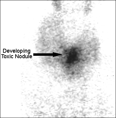 Image A: 99m Tc Thyroid scan in Multinodular Goitre large image