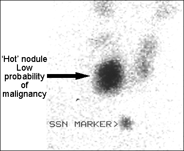 Image B: 99m Tc Thyroid scan 'Hot' nodule with low probability of malignancy large image