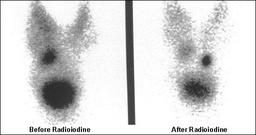 Toxic multinodular goitre with retrosternal extension large image