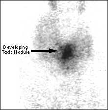 Image A: 99m Tc Thyroid scan in Multinodular Goitre