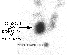 Image B: 99m Tc Thyroid scan 'Hot' nodule with low probability of malignancy
