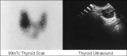 Image A: Thyroid Cyst large image