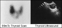Image A: Thyroid Cyst