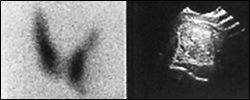 Image B: 99m Tc Thyroid scan: Non functioning cold nodule