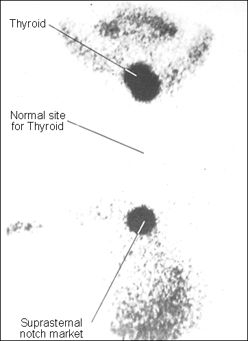 Lingual Thyroid and Thyroglossal cyst large image