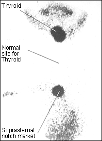 Lingual Thyroid and Thyroglossal cyst