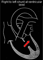 Right to left (ventricular level)