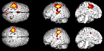 Functional neuroimaging