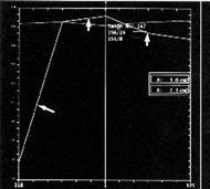 4.	MR mammography 02