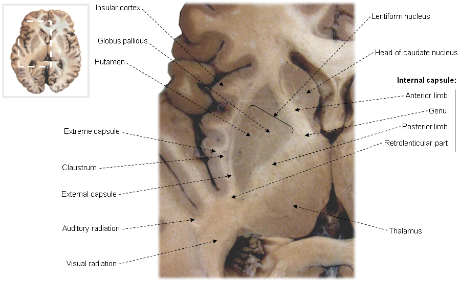 Detail of horizontal section through the internal capsule and related structures