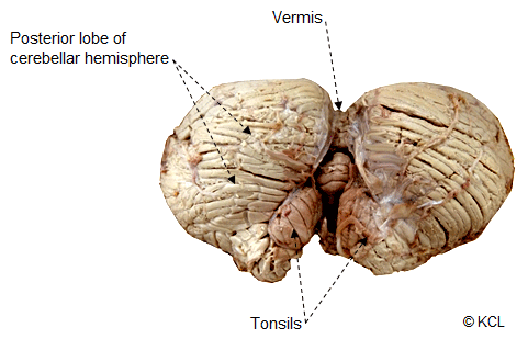 Cerebellum - External features visible when detached from the brainstem: Inferior view