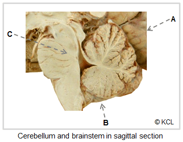 Cerebellum and brainstem in sagittal section, with viewpoints A, B & C