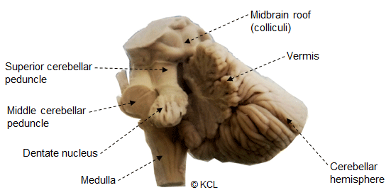 Labelled dissection of the cerebellum to show the dentate nucleus and the superior cerebellar peduncle (dorsolateral view)