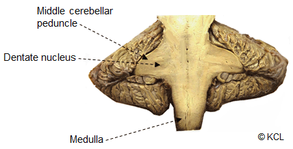 Labelled middle cerebellar peduncle – the largest of the three, seen here in coronal section