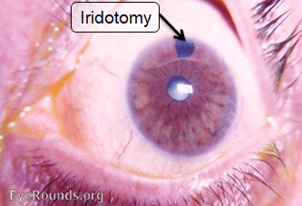 image of an eye with iridotomy