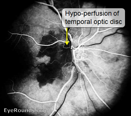 Fluorescein angiogram shows ischaemia of the optic disc and surrounding choroid