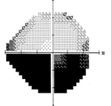 Humphrey visual field test showing an inferior altitudinal field defect