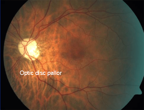 retina image for optic disc pallor
