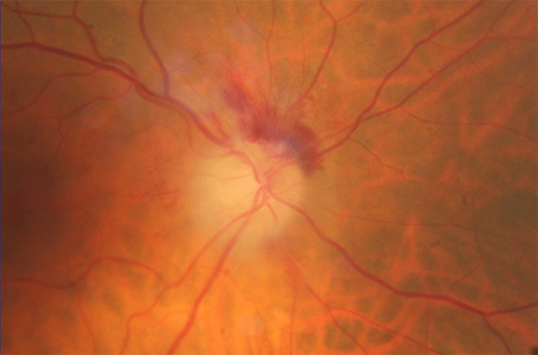 Swollen optic disc with flame shaped haemorrhage