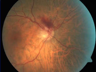 retina image for swollen disc with flame shaped haemorrhage