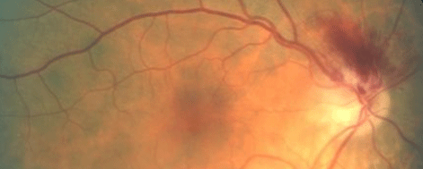 retina image for non-arteritic anterior ischemic optic neuropathy