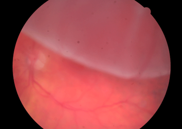 retina image for bullous superior retinal detachment
