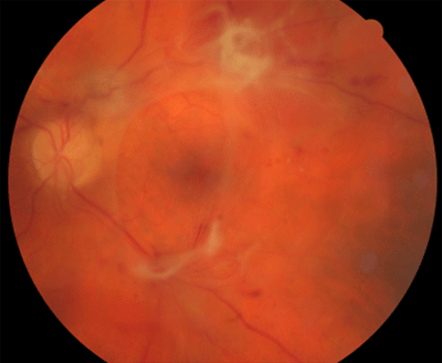 retina image for fibrovascular proliferation