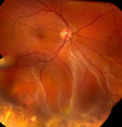 retina image for inferior retinal detachment