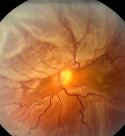 retina image for retinal detachment