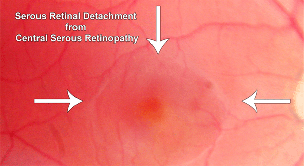 Serous retinal detachment from central serous retinopathy