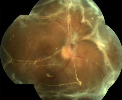 retina image for tractional retinal detachment