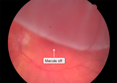 retina image for macula off